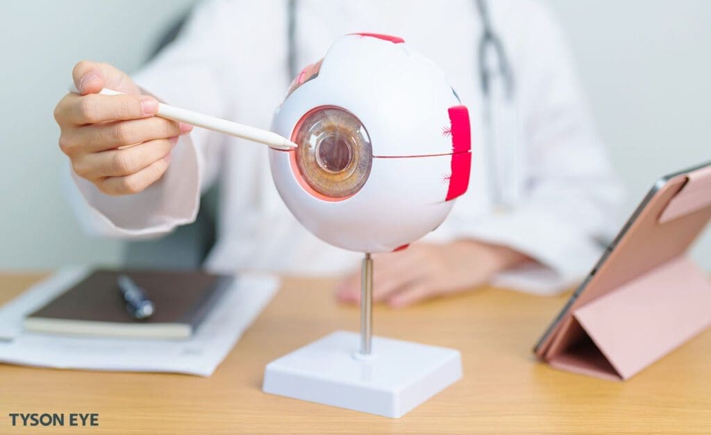 Signs You Might Have Cataracts. Doctor using a diagram to illustrate cataracts.