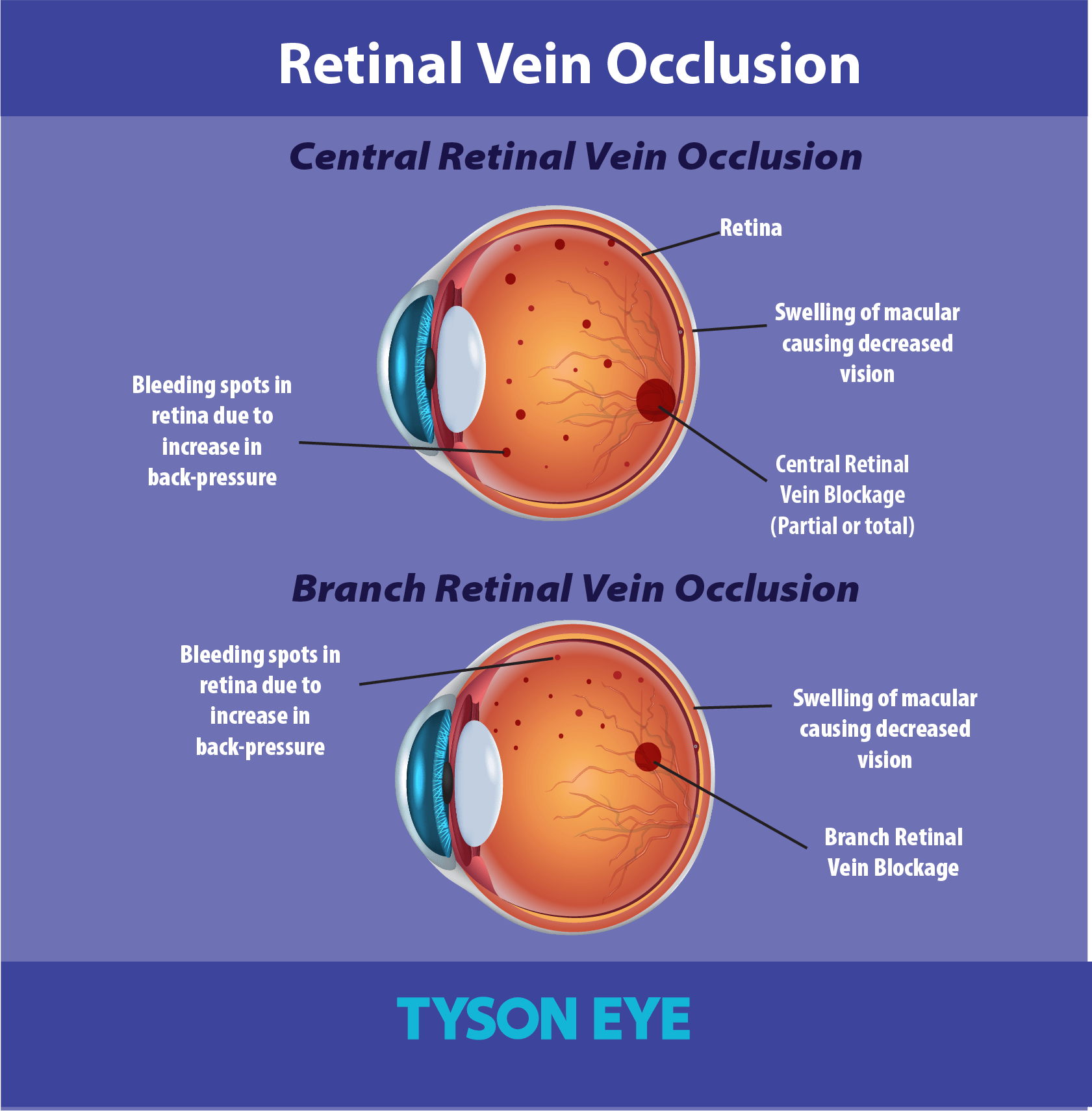 Retinal Vein Occlusion Infographic